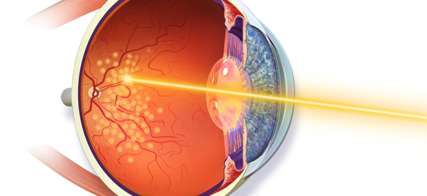 Retinal Laser Injection Surgery