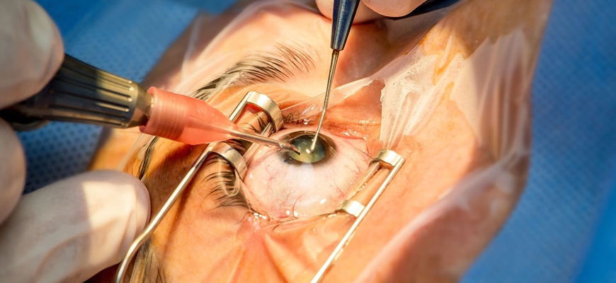 Stitchless Cataract Surgery